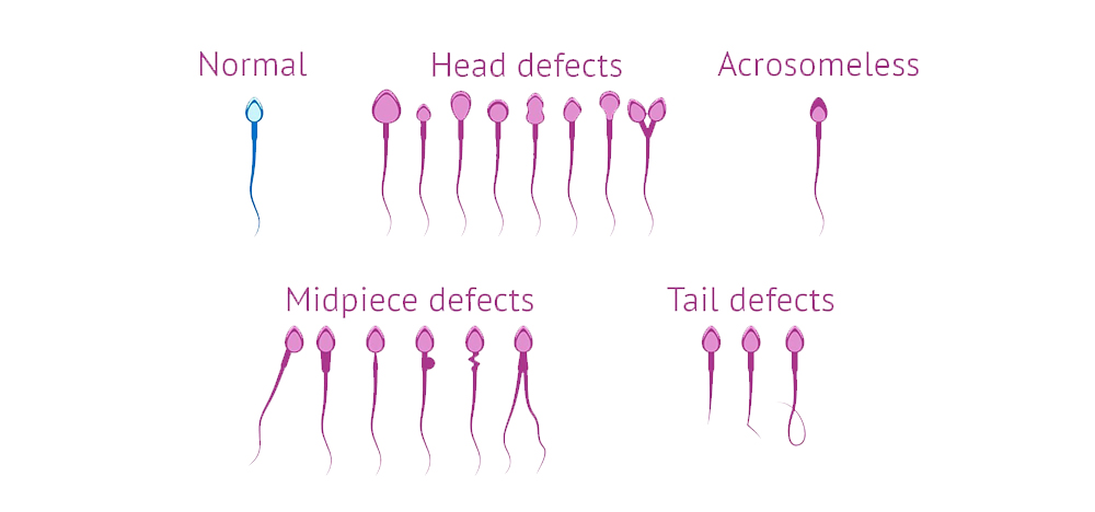 sperm abnormality shreshta fertility centre
